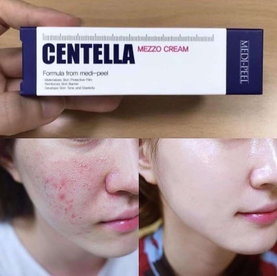 Medi-Peel Centella mezzo cream 30ml เหมาะกับผู้ที่เป็นสิว ช่วยเรื่องสิวและลดรอยแดงจากสิว ให้ความชุ่มชื้น อุดมไปด้วยส่วนผสมจากธรรมชาติ ปลอดภัยสำหรับผิวบอบบาง